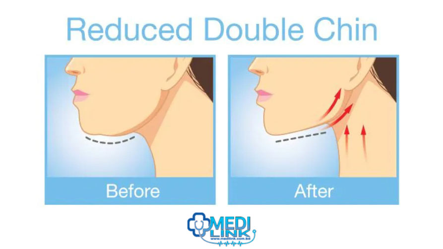 Natural Remedies for Double Chin